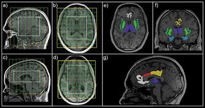 Effect of Ketamine on Limbic GABA and Glutamate: A Human In Vivo Multivoxel Magnetic Resonance Spectroscopy Study